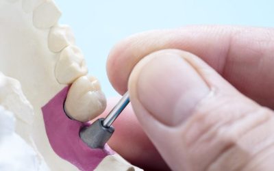 ¿Cuándo hay que visitar a un implantólogo dental?