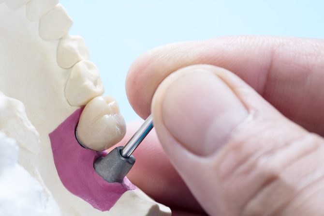 ¿Cuándo hay que visitar a un implantólogo dental?