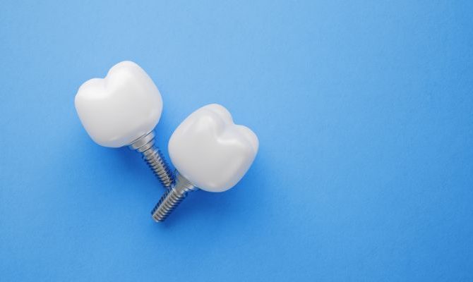 Implantes dentales en pacientes mayores: ¿son adecuados?